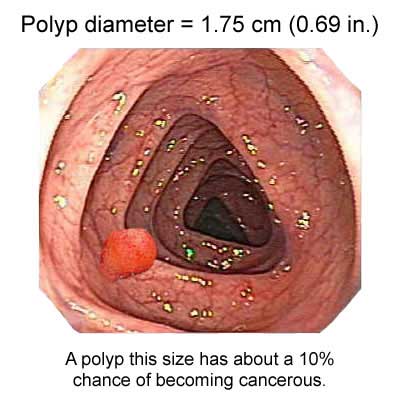 colon polyp